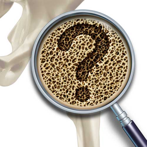 Osteoporos Typ 1 & Typ 2 Viktigt med rätt behandling
